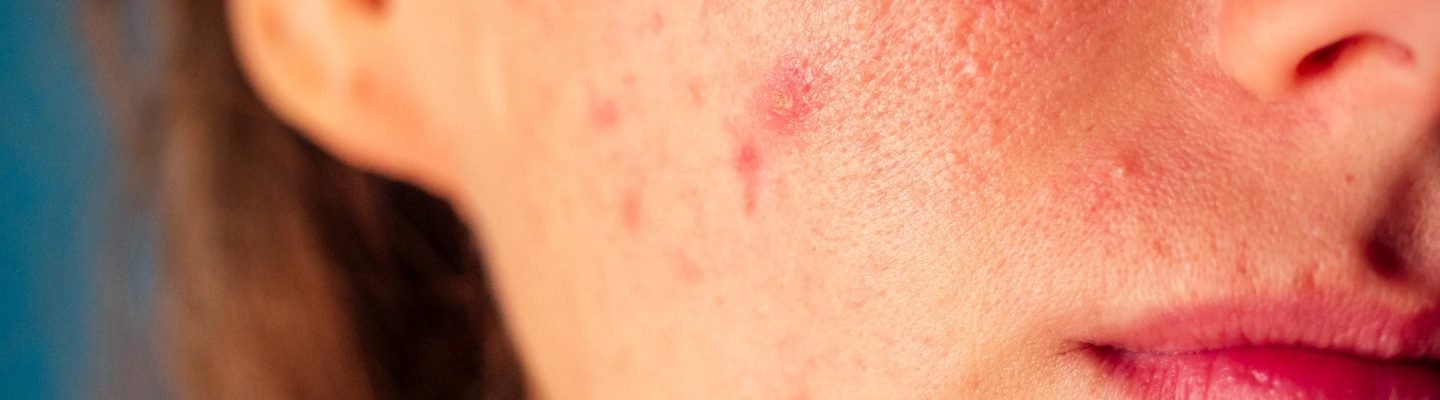 Mga Haka-haka Tungkol sa Tagihawat (acne)