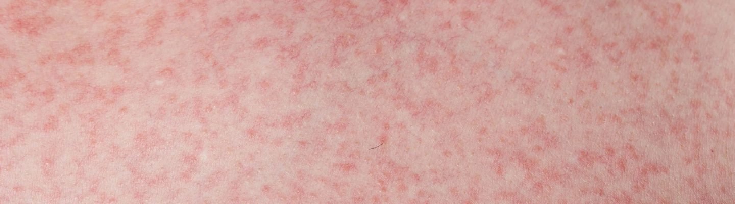 Makati ba ang rashes nang may dengue fever?