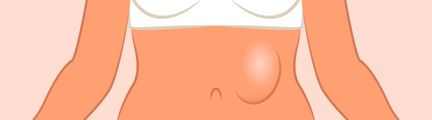 Luslos (Hernia)