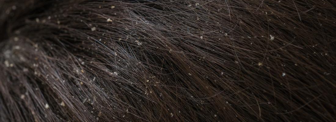 Balakubak o dandruff sa mga bata