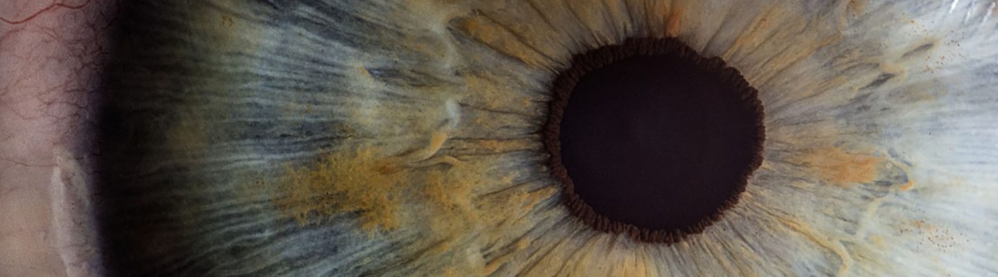 Kanser sa Mata (Eye Cancer)