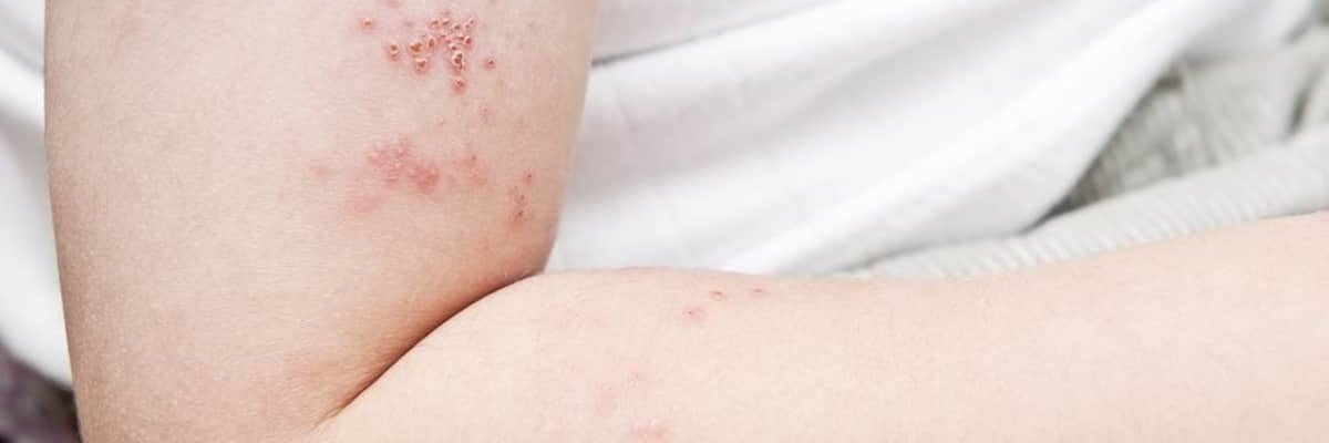 ‘Reactivation ng bulutong’: Herpes zoster o shingles