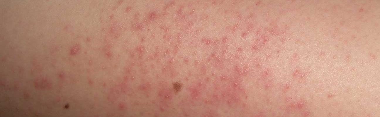 Keratosis pilaris (KP): Mga butlig sa braso lalo na sa mga binata