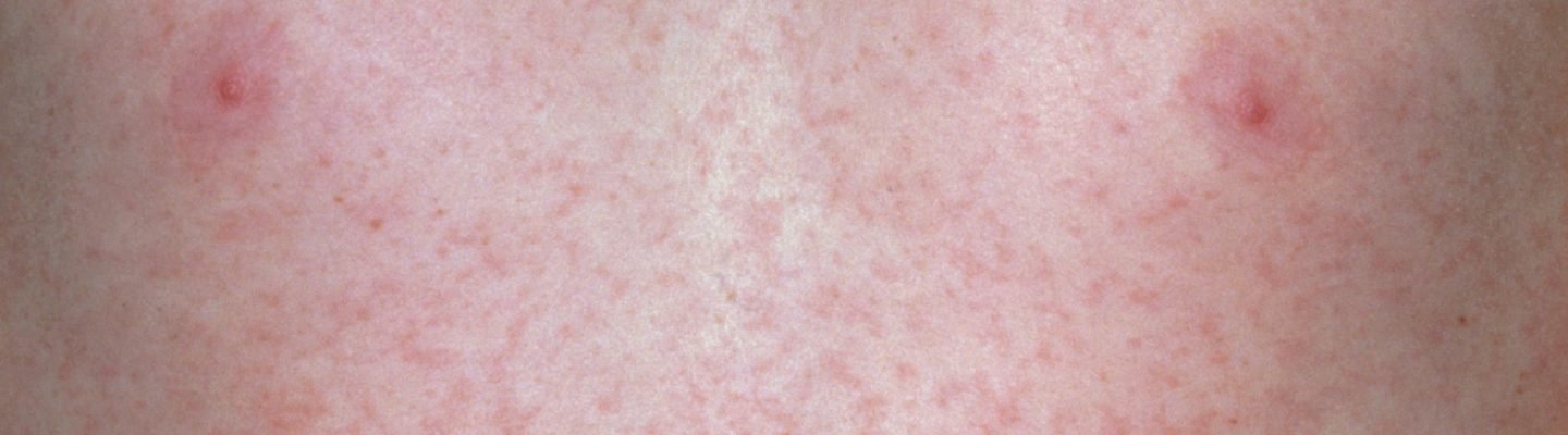 Paano malaman kung may tigdas-hangin o german measles?