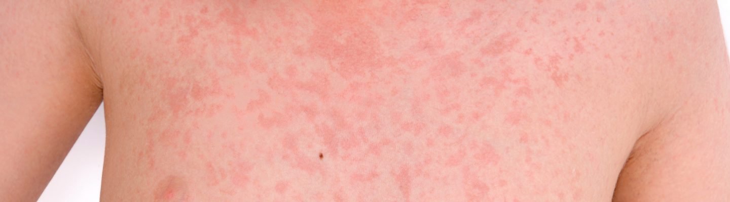 Ano ang sintomas ng tigdas-hangin o german measles?