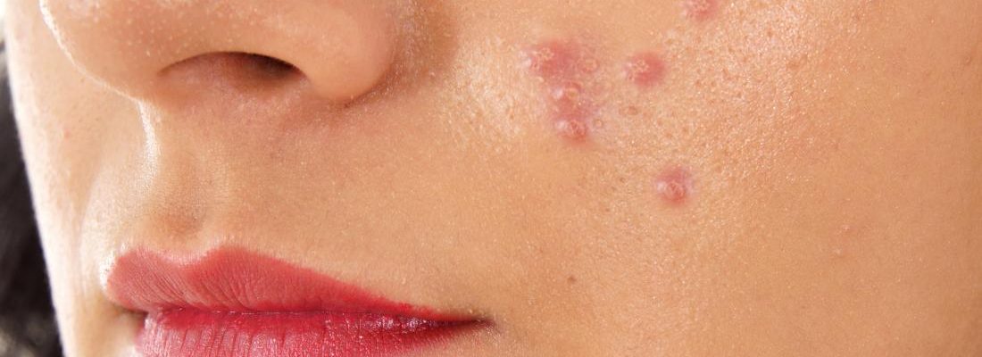 Tigyawat o Pimples (Acne)