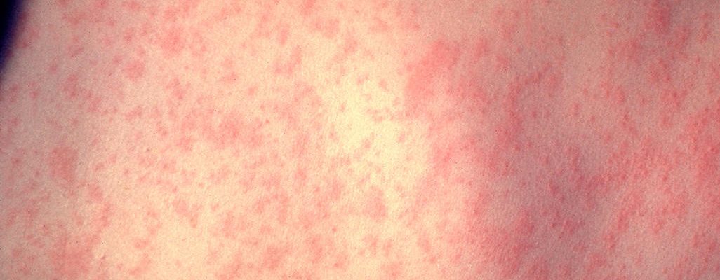 Ano ang gamot sa tigdas-hangin o German measles?