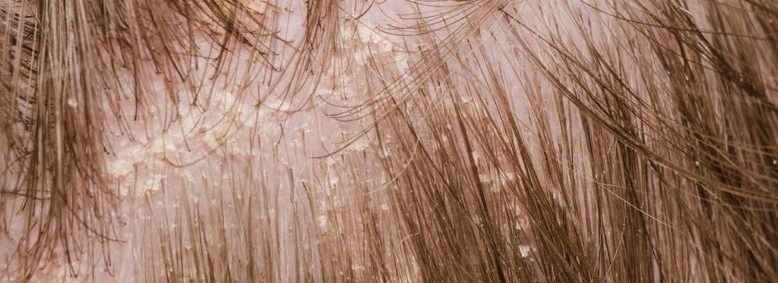 Ano ang gamot sa balakubak o dandruff?