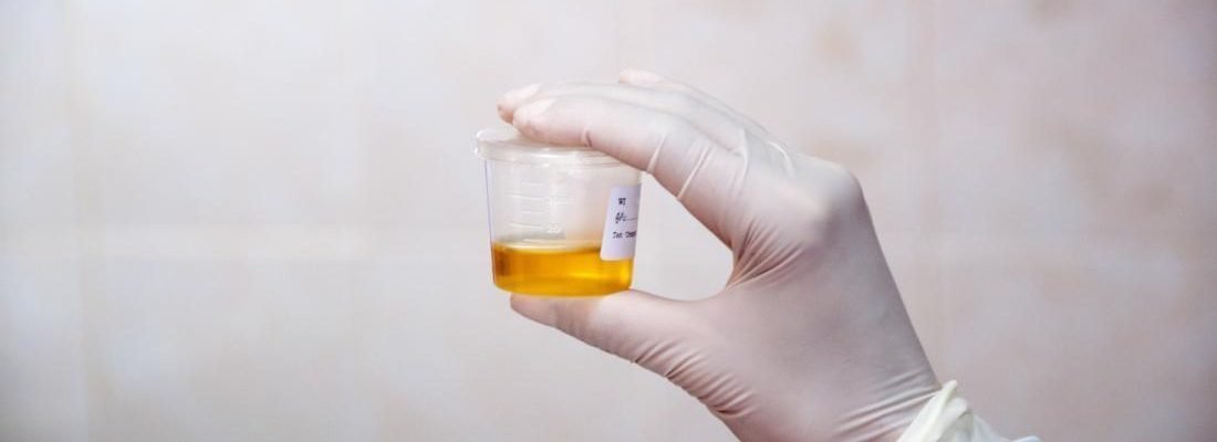 Urinalysis (Pagsusuri sa Ihi)