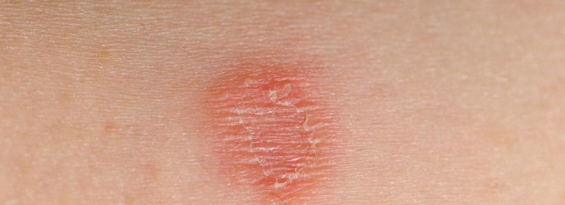 Ano ang mga sintomas ng Buni o Ringworm?