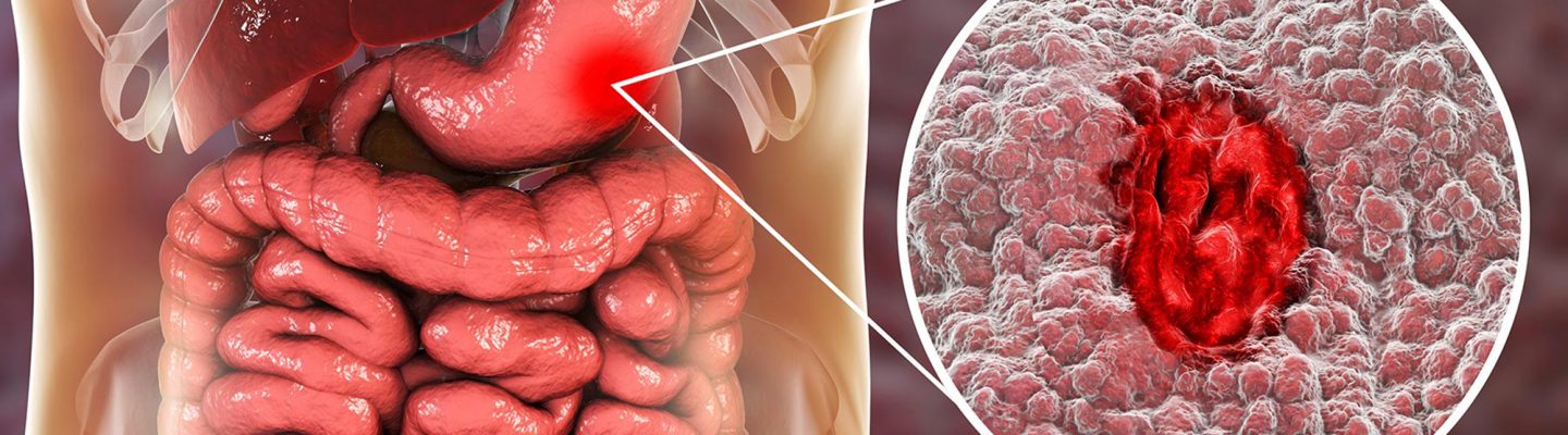 Ulcer sa Sikmura o Peptic Ulcer