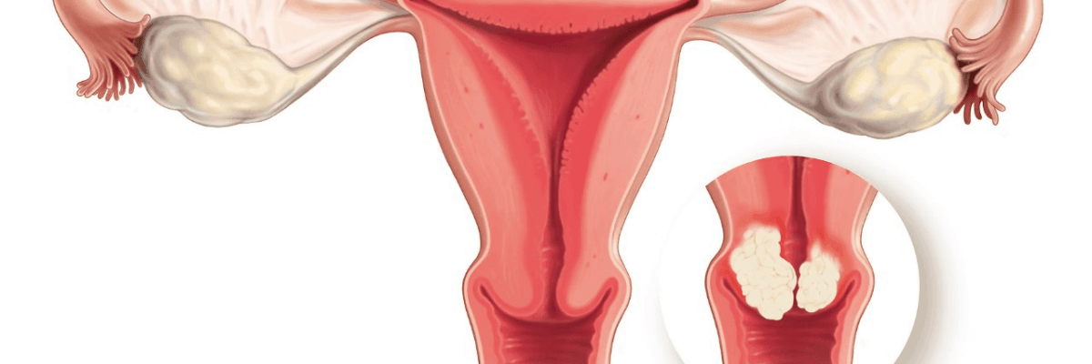 Balitang Kalusugan: Libreng Bakuna Laban sa Cervical Cancer, Tetanus, at Diphtheria, Ipamimigay ng DOH nang Libre