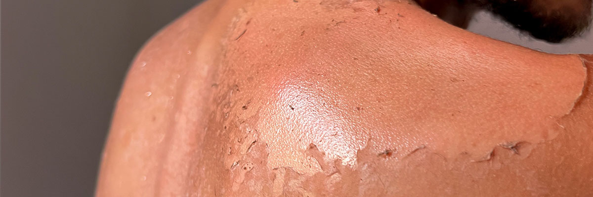 Sunburn o ang Pagkasunog ng balat dahil sa araw