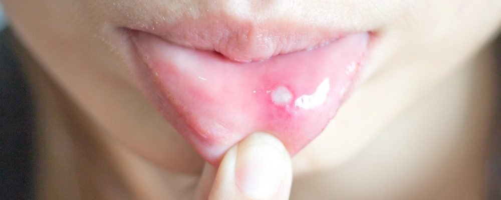 Paano makaiwas sa Singaw o Mouth Sores?