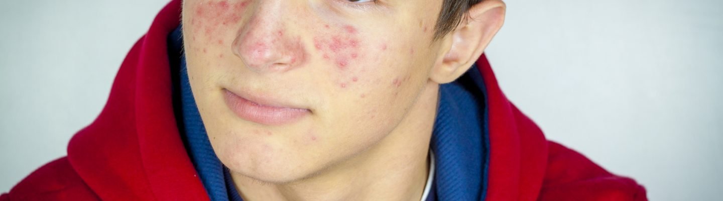 Paano matanggal ang pimples sa isang binata?