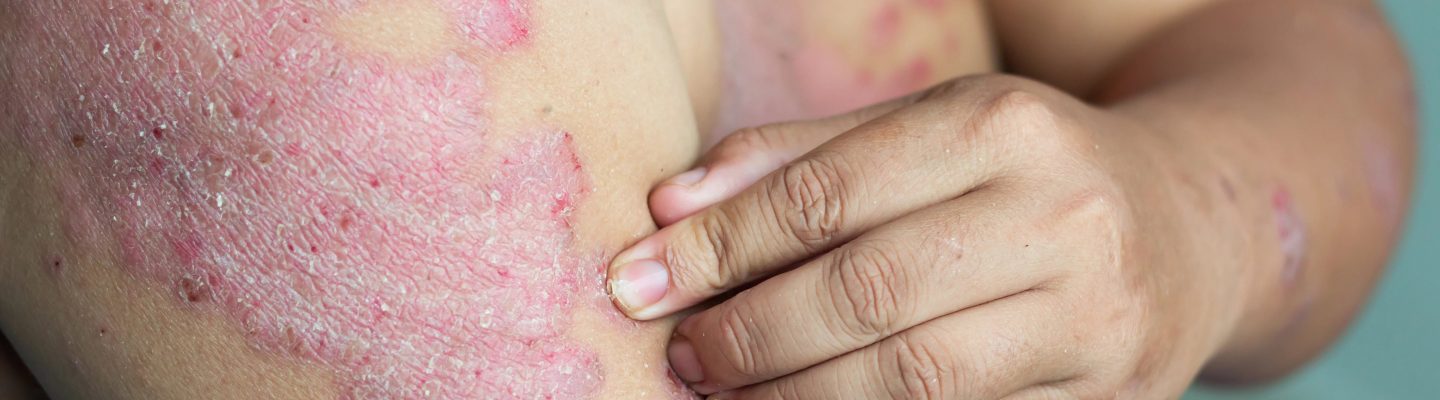 Psoriasis