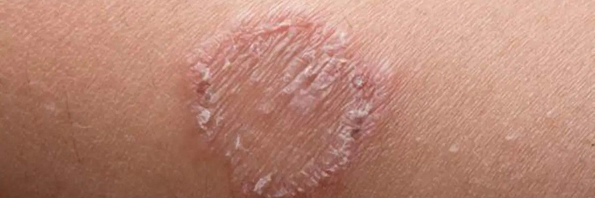 Paano malaman kung may Buni o Ringworm?