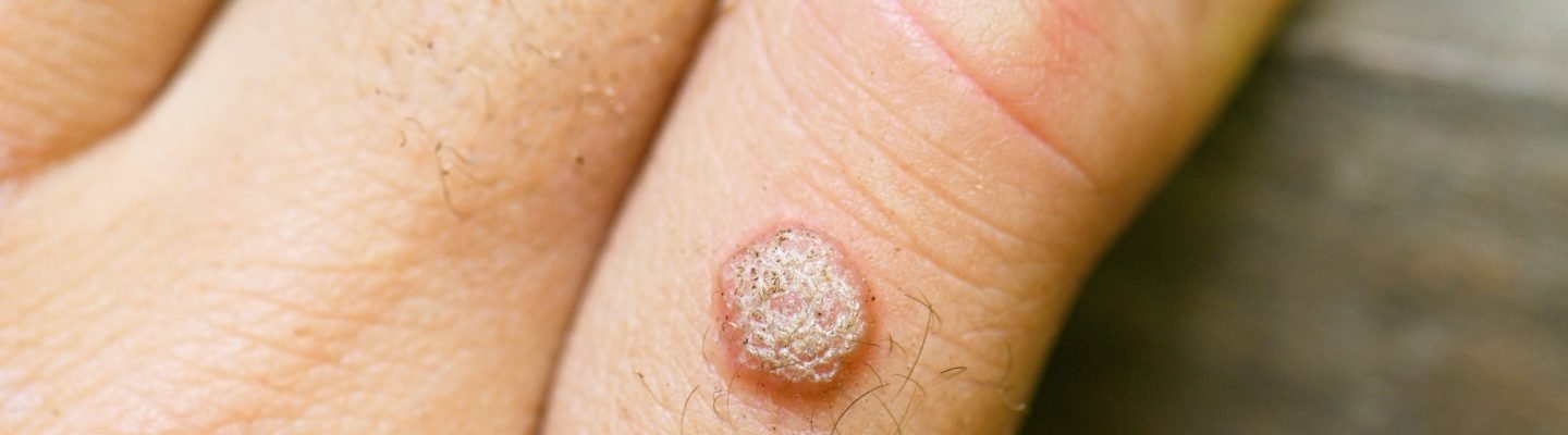 Paano makaiwas sa Kulugo o warts?