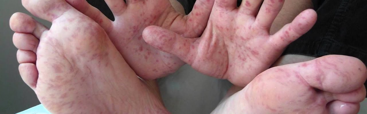 Balitang Kalusugan: Kaso ng Hand Foot and Mouth Disease sa bansa, tumataas