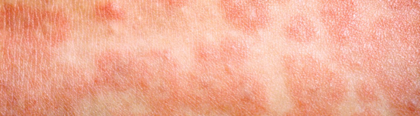 Paano maka-iwas sa tigdas-hangin o german measles?
