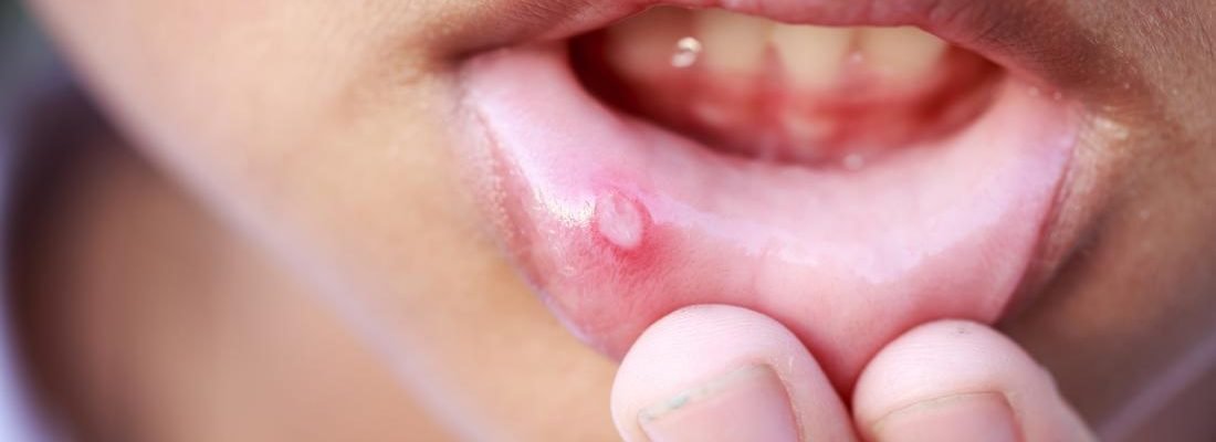Singaw (Mouth Sores)