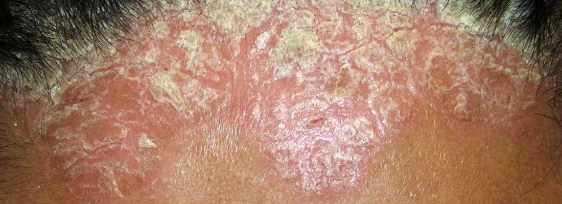Paano makaiwas sa Psoriasis?