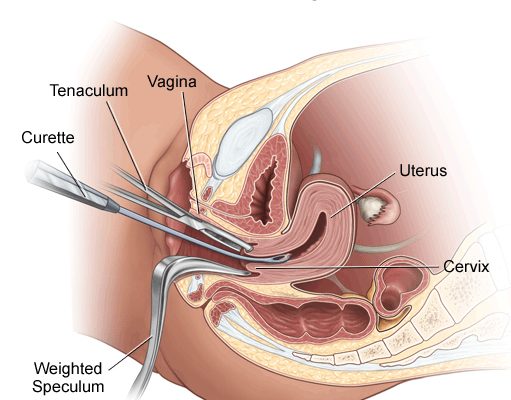 Mga Kaalaman Tungkol sa Raspa (Dilation & Curettage)