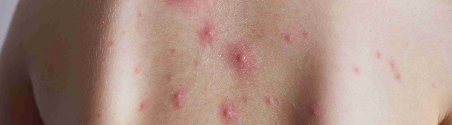 Ano ang mga sintomas ng Bulutong o Chickenpox?