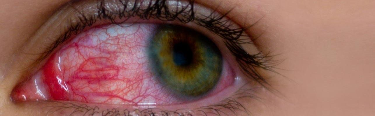 Ano ang mga sintomas ng Sore Eyes?