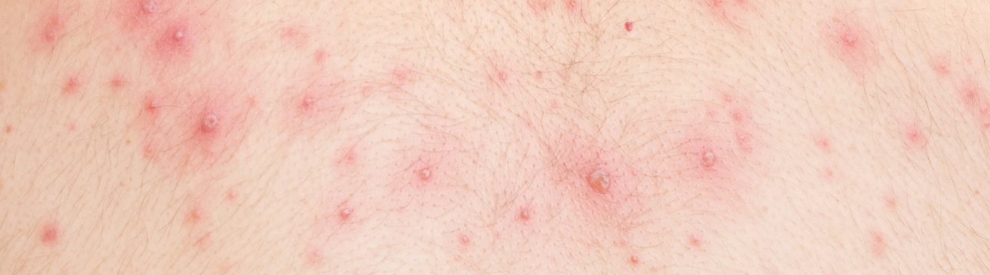 Paano malaman kung may bulutong o chickenpox?