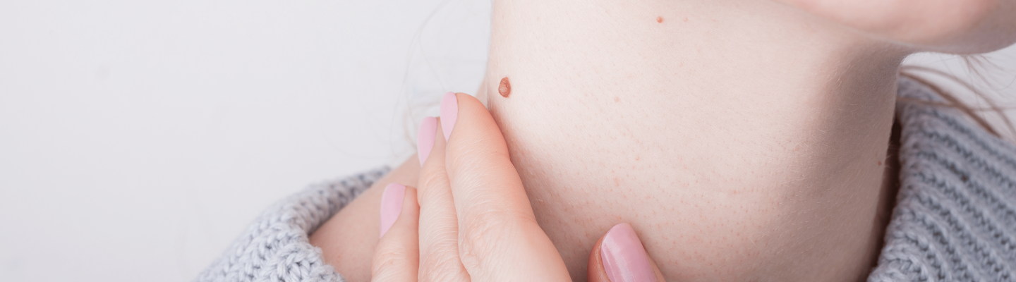 Ano ang mga sintomas ng kulugo o warts?