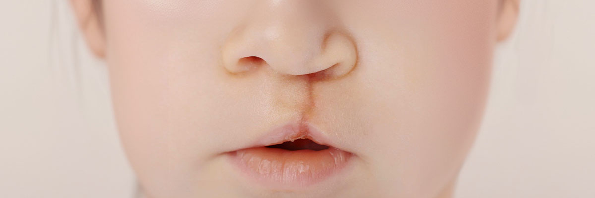 Bingot at Ngongo (Cleft Lip and Palate)