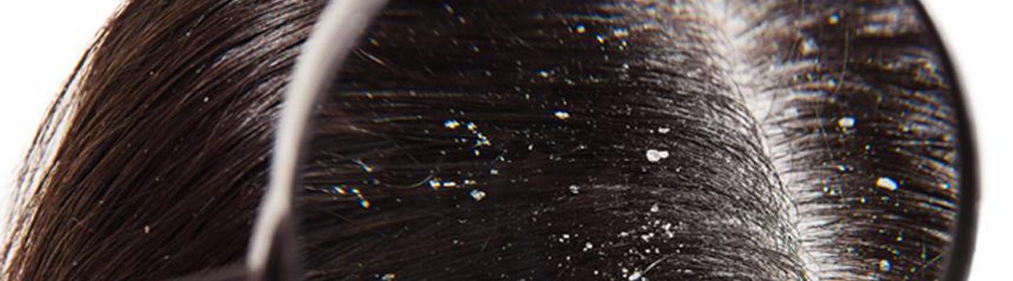 Balakubak (Dandruff)