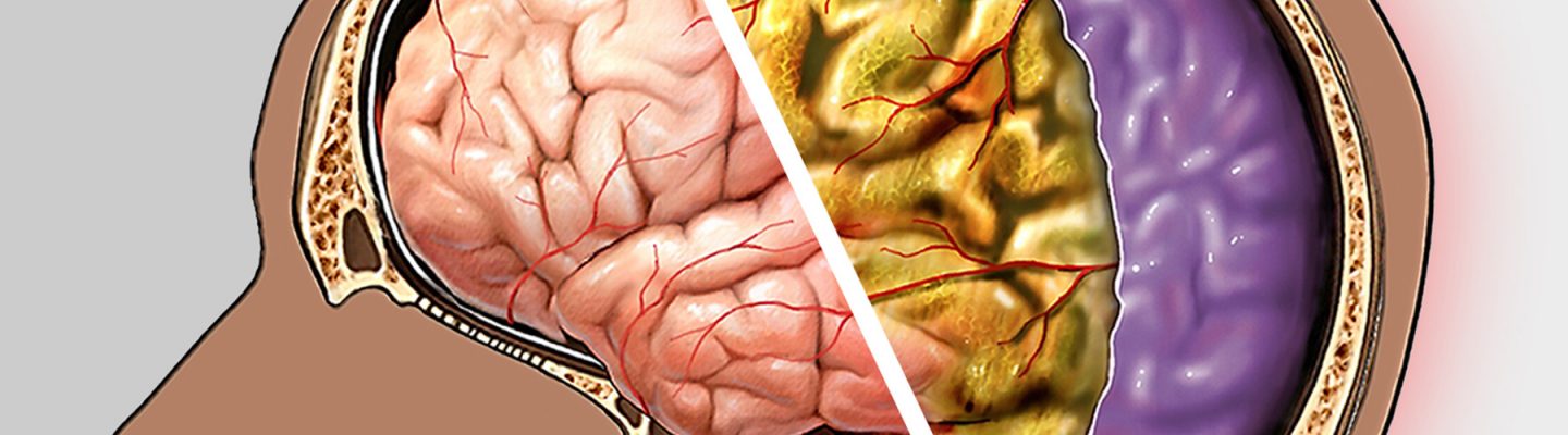 Meningitis