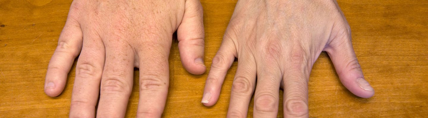 Acromegaly