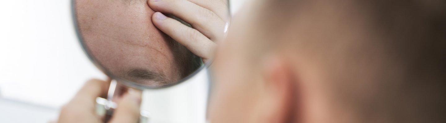Pagkakalbo (Hair Loss)