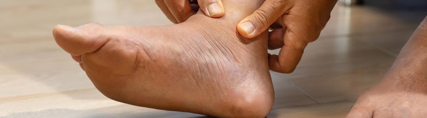 Pamamaga ng Paa (Swollen Feet)
