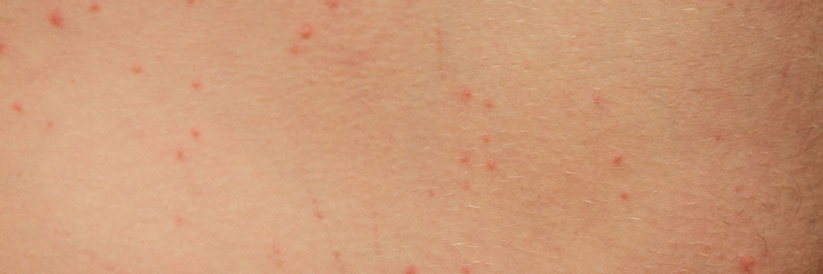 Kagat ng Surot (Bed Bug Bites)